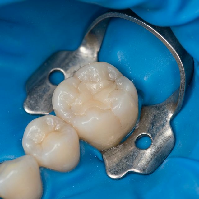 Intraoral view of a tooth filling under rubber dam